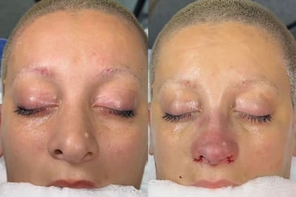 El antes y después de furia tras su rinoplastia