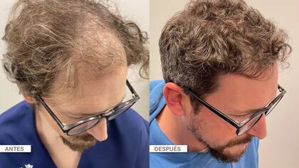 El antes y el después de un microtrasplante capilar pelo por pelo, con resultados sumamente naturales.