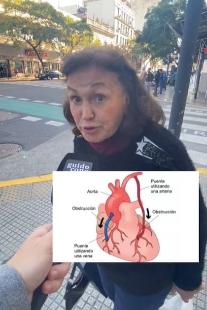 El bypass coronariom, uno de los inventos argentinos más reconocidos por la gente que respondió en el video que se volvió viral