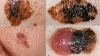 El cambio de aspecto de un lunar, como en estas cuatro imágenes, puede ser un signo de melanoma