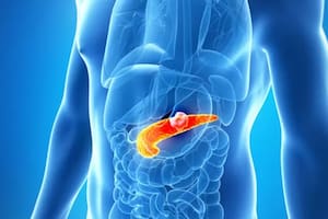 Dos fármacos despiertan esperanza contra un tipo de cáncer cuya sobrevida suele ser menor a un año