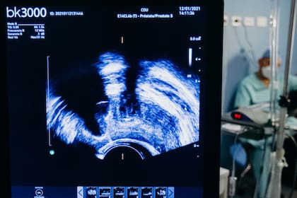 El cáncer de próstata es absolutamente tratable