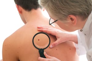 Lo que debés saber sobre el tipo más común de cáncer de piel