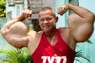Murió el “Popeye brasileño”: se había inyectado aceite en los bíceps