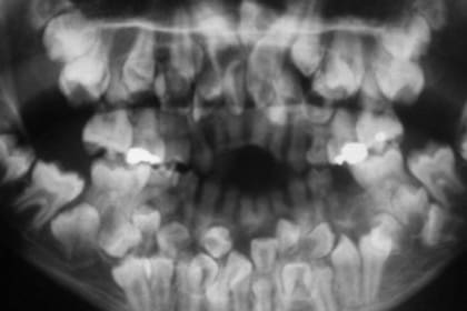 El caso de la niña de 11 años con 81 dientes sorprendió a los especialistas que hicieron un informe con su caso para publicarlo en revistas científicas
