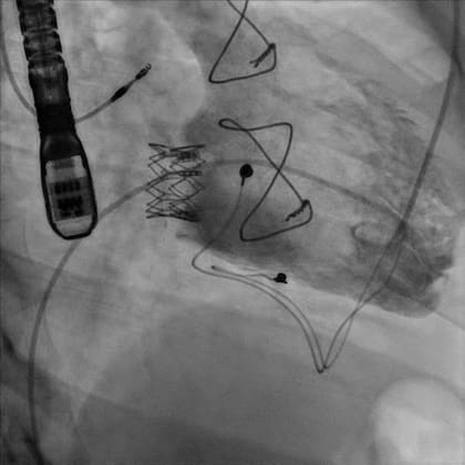 El catéter introduce la válvula cardíaca plegada