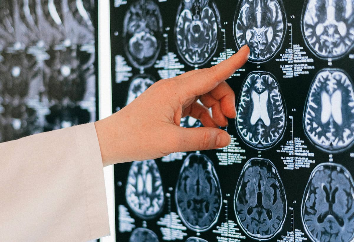 When to Worry: Memory Loss & Early Alzheimer’s Signs Explained by a Neurologist When to Worry: Memory Loss & Early Alzheimer’s Signs Explained by a Neurologist