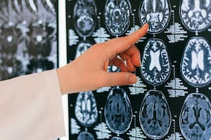 Un neurólogo explicó cuándo una pérdida de memoria puede ser indicio de Alzheimer