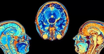 La tecnología permite detectar tempranamente enfermedades que afectan al cerebro
