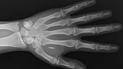 El chip de Walletmor se pone en la mano de la personas tras una anestesia local