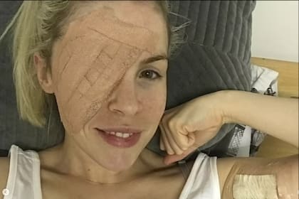 El cirujano le extirpó todo el párpado inferior porque el tumor estaba muy extendido (Foto: Daily Mail)