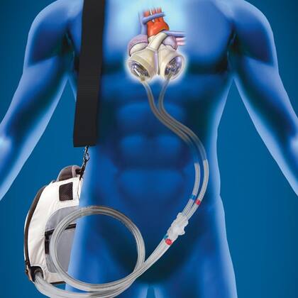 El cirujano le propuso reemplazar su dañado corazón por una máquina encargada de suplir las funciones de su órgano (Twitter:@Cancer_992)