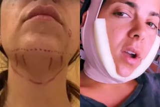 En qué consiste la intervención estética a la que se sometió Belu Lucius