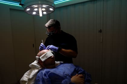 El cirujano Sebastián Mítolo haciendo la intervención capilar, en el centro de implante Capilea de Ramos Mejía
