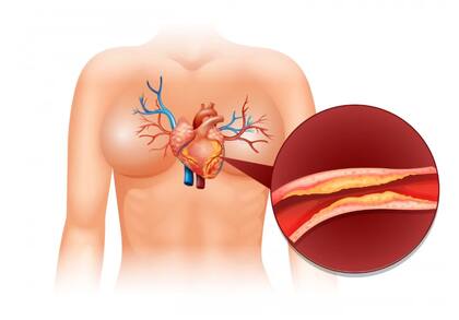 El colesterol afecta a las arterias.
