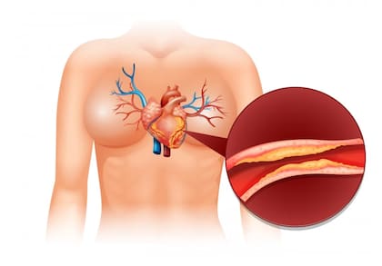 El colesterol alto puede ser hereditario; esto significa que se puede transmitir del padre y la madre a los hijos a través de los genes