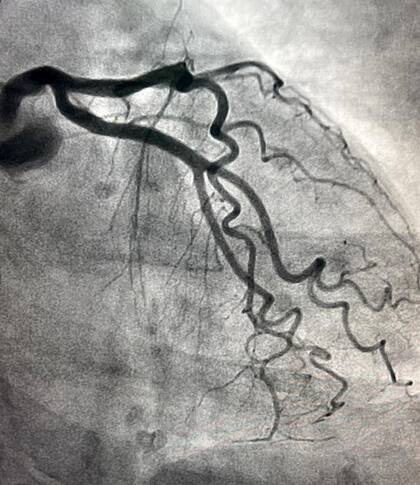 El contraste, en este caso usado para hacer visible una arteria coronaria; el inyectable es otro de los productos que falta