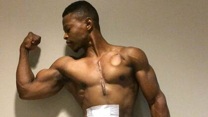 El corazón artificial de Jones tiene dos tubos que salen del cuerpo y están conectados a una máquina que lleva en una mochila