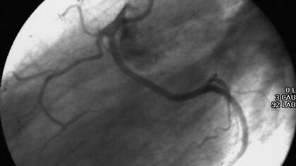 El corazón y sus arterias principales