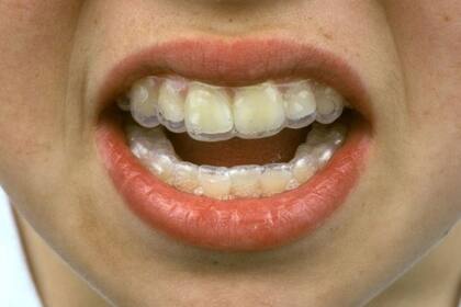 El costo de los alineadores transparentes puede subir a más de US$5,000.