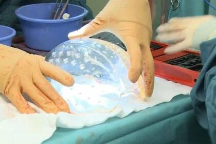 El cráneo que se le implantó a una joven de 22 años fue realizado en una impresora 3D