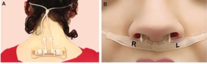 El dispositivo portátil que registró el flujo de aire por cada fosa nasal durante 24 horas ininterrumpidas