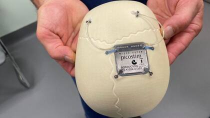 El dispositivo que le implantaron al chico inglés que sufre un tipo de epilepsia muy severo.