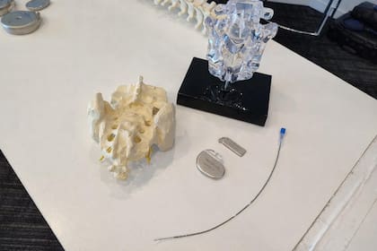 El dispositivo subcutáneo (en la imagen, en dos variantes) de neuromodulación para incontinencia urinaria envía señales eléctricas a los nervios sacros que controlan la vejiga y la musculatura del piso pélvico que interviene en la micción