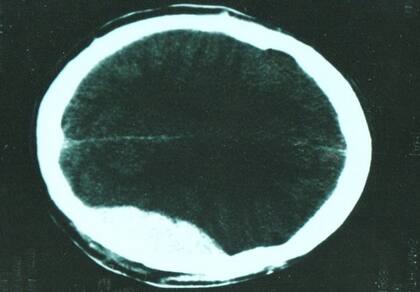 El escaneo del cerebro de Thomas Leeds que muestra una hemorragia