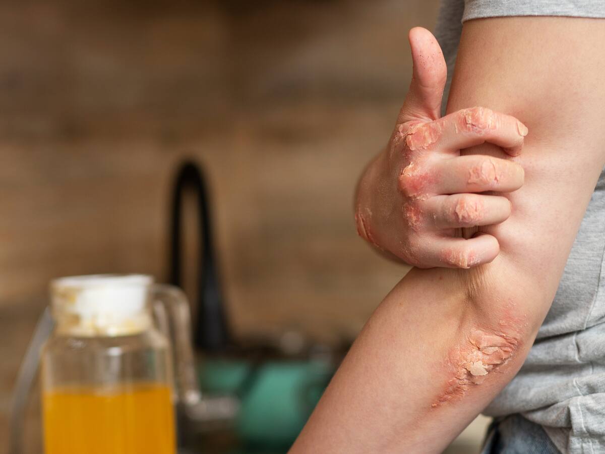 Uma doença que muitos erroneamente chamam de “nervosa” e que não foge à regra para a pele Uma doença que muitos erroneamente chamam de “nervosa” e que não foge à regra para a pele
