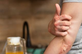 La enfermedad que muchos tildan de “nerviosa” por error y que no es exclusiva de la piel