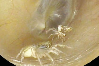 El especialista que trató a la paciente ya había visto otros casos de insectos dentro de los oídos, pero nunca se había encontrado con uno que hasta cambiara su piel en el conducto auditivo y por eso publicó el informe