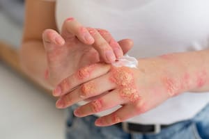 Psoriasis: en qué consiste esta enfermedad genética y por qué es clave un diagnóstico a tiempo