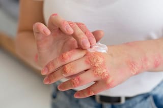 Psoriasis: en qué consiste esta enfermedad genética y por qué es clave un diagnóstico a tiempo