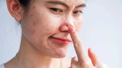 El estrés estimula las glándulas de la piel que producen una sustancia aceitosa llamada sebo, que puede obstruir los poros y contribuir al acné