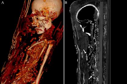 El estudio demostró que la mujer presenta cuentas de collar alrededor del cuello