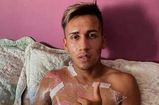 Las fotos del juvenil de Vélez Villalón que se quemó el rostro y el cuerpo