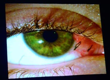 El glaucoma es la segunda causa de ceguera