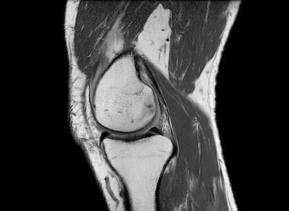El grupo de músculos que rodea la rodilla es fundamental para su funcionamiento