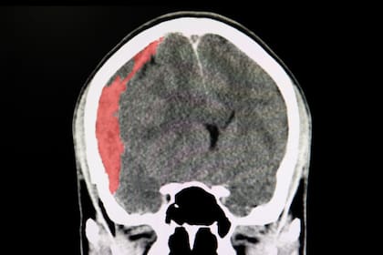 Un hematoma subdural es la acumulación de sangre y de productos de descomposición de la sangre entre la corteza cerebral y la duramadre, que es la meninge exterior