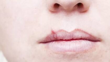 El herpes simple 1 y 2 causan llagas en la comisura de la boca y en la región genital