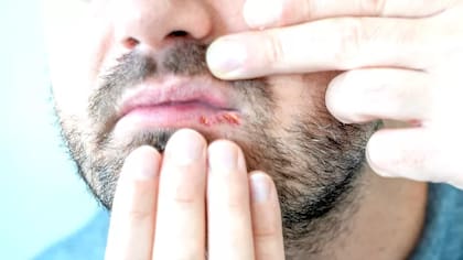 El herpes también puede causar llagas en la boca