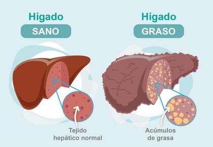 El “hígado graso” supone el depósito excesivo de grasa en el hígado