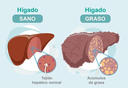 El “hígado graso”, también denominado “esteatosis hepática” supone el depósito excesivo de grasa en el hígado (imagen ilustrativa)