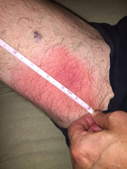 El hombre explicó que sufrió la picadura instantes después de bajar de una motocicleta