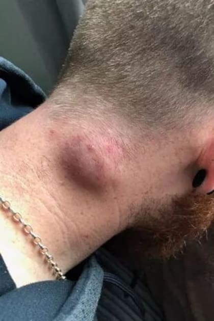 El hombre padece una extraña enfermedad que causa cicatrices y nódulos parecidos a forúnculos que aparecen regularmente en el cuerpo (Foto: Mirror)