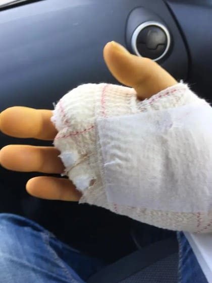 El hombre perdió su dedo tiempo antes del trágico desenlace. Fuente: Henrik Kriegbaum Plettner/Facebook