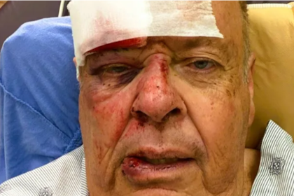 El hombre se encuentra hospitalizado, recibe tratamientos para superar los piquetes de abeja y pronto será sometido a una cirugía facial