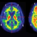 ¿Un simple análisis de sangre puede predecir si alguien tendrá Alzheimer? Esta es la respuesta de los expertos