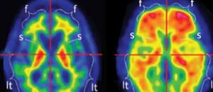 ¿Un simple análisis de sangre puede predecir si alguien tendrá Alzheimer? Esta es la respuesta de los expertos